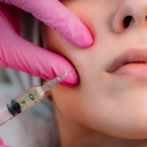 Dermal Filler Injection for Cheeks